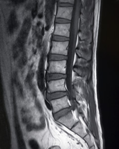 Lumbar epidural steroid injection how long to work