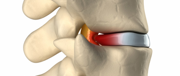 What Is A Herniated Disc?