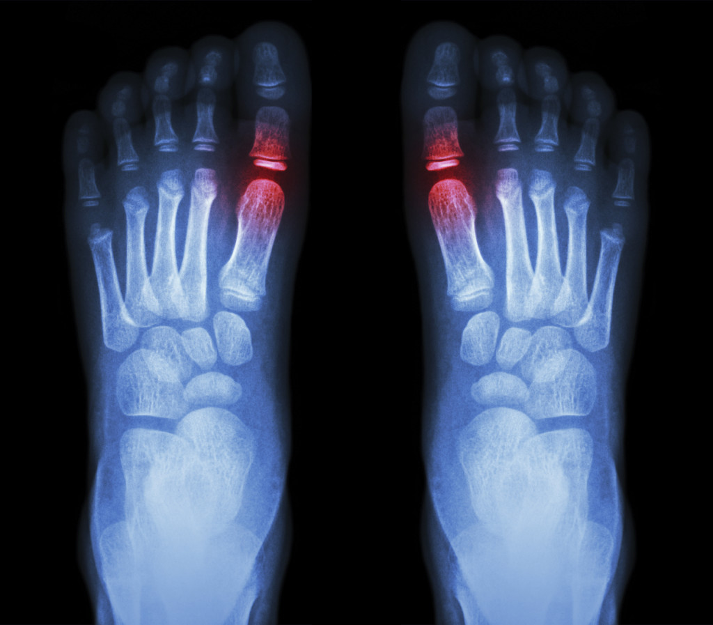 Remove and Prevent Gout Joint Pain | Comprehensive Pain Management Center