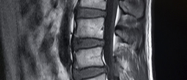 Herniated Disk: What It Is and How to Treat It