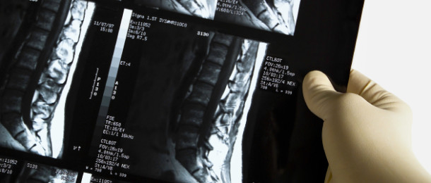 Overcoming Scoliosis