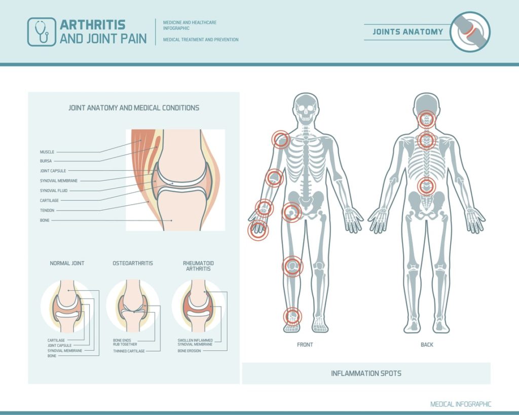 Different Types Of Arthritis And Their Symptoms