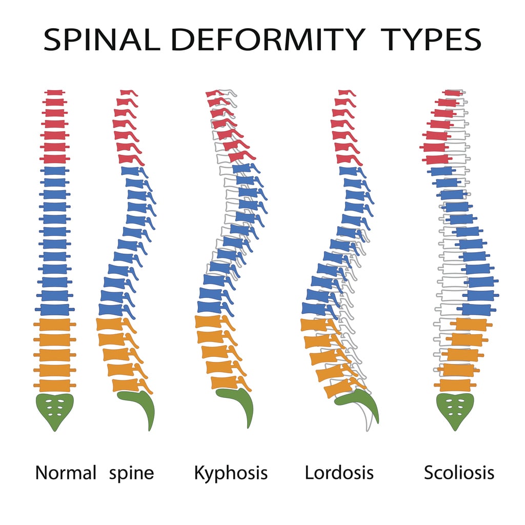 Scoliosis Awareness Month What to Know About This Disease CPMC